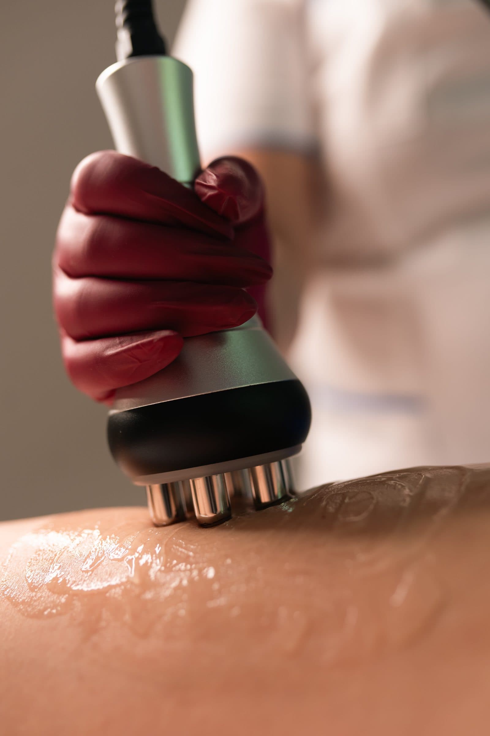 A metal electrode head during an RF treatment